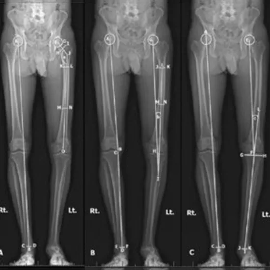 X-Ray Both Lower Limb